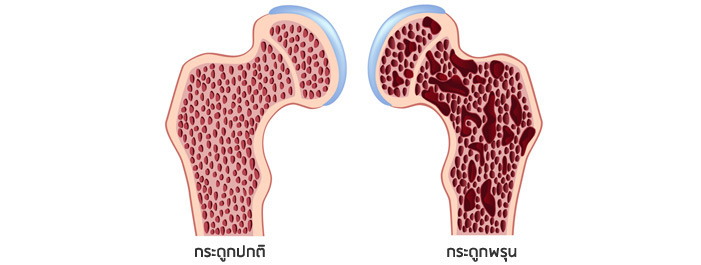 กระดูกพรุน
