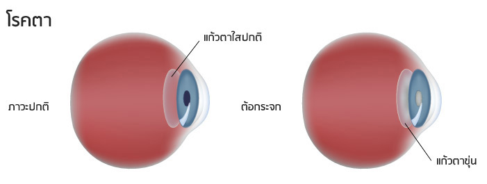 ต้อกระจก ต้อกระจก