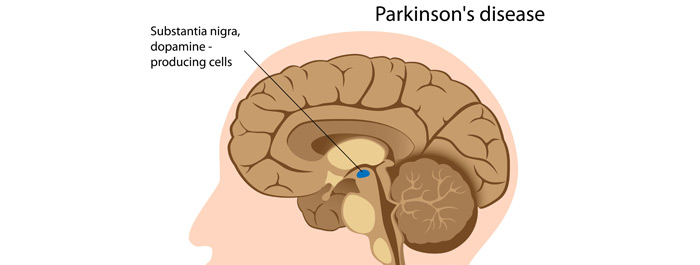 พาร์กินสัน