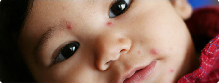 อีสุกอีใส อีสุกอีใส