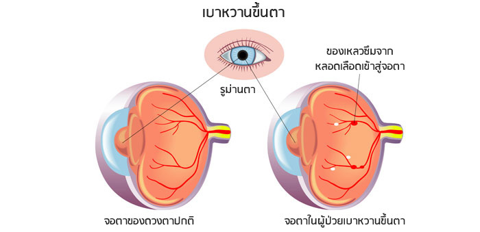 เบาหวานขึ้นตา