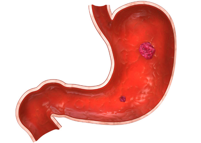 แผลในกระเพาะอาหาร